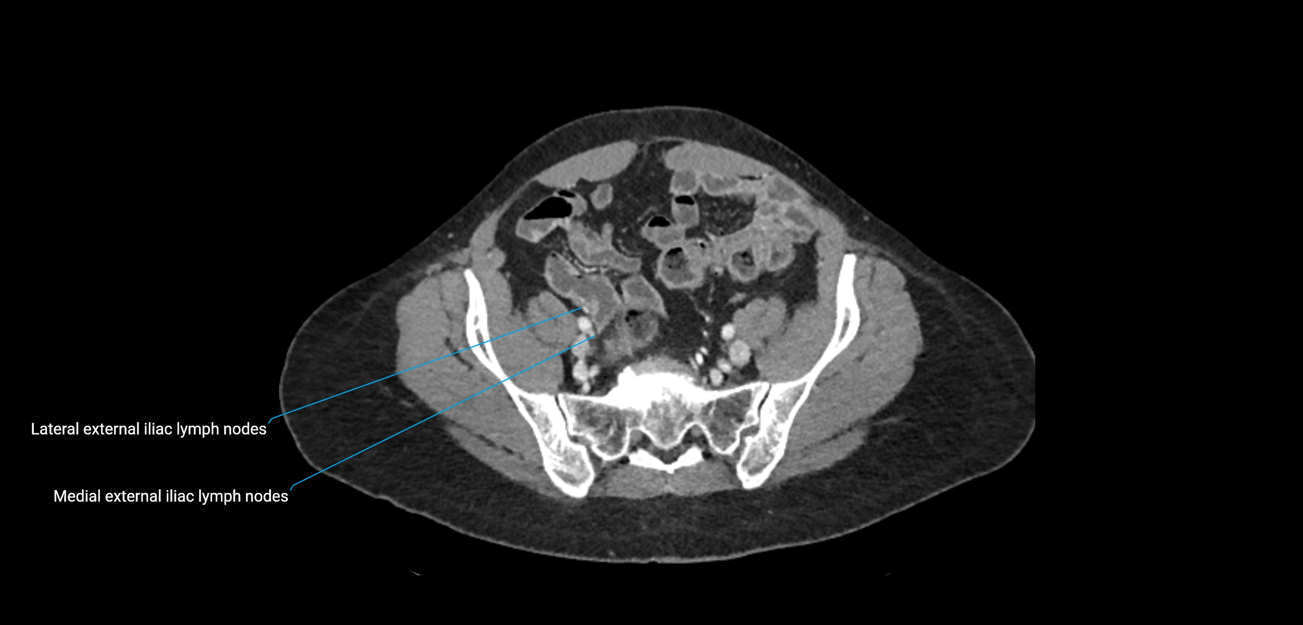 CT ct abdominal lymph nodes  axial cross sectional anatomy  enchanced radiology image -img-00002-00327.webp